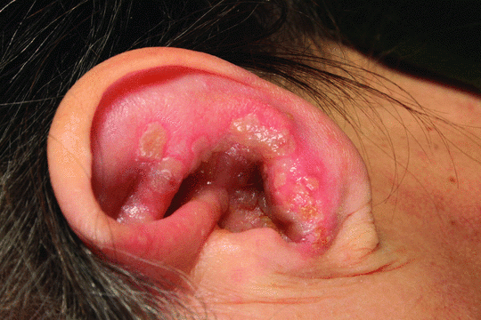 Zona tai có thể gây liệt mặt, giảm sức nghe