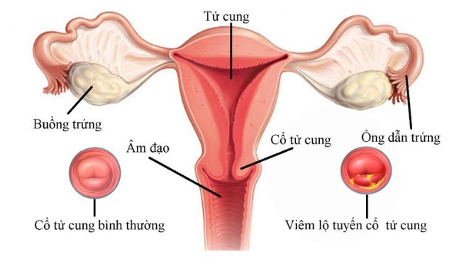 Viêm lộ tuyến cổ tử cung: Nguyên nhân, dấu hiệu, cách chẩn đoán và phòng ngừa