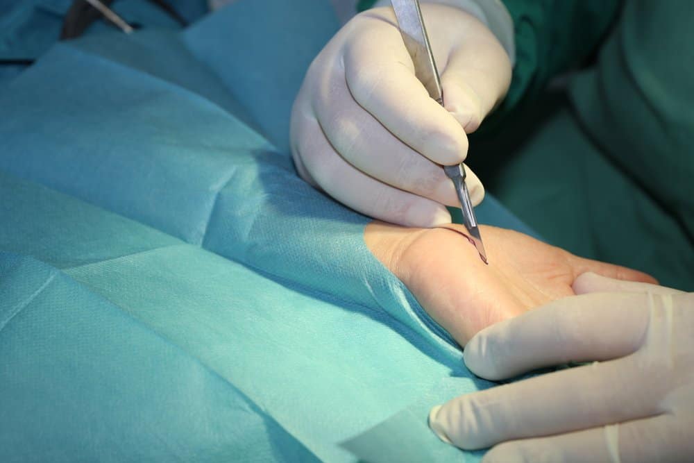 Hội chứng ống cổ tay và cách điều trị