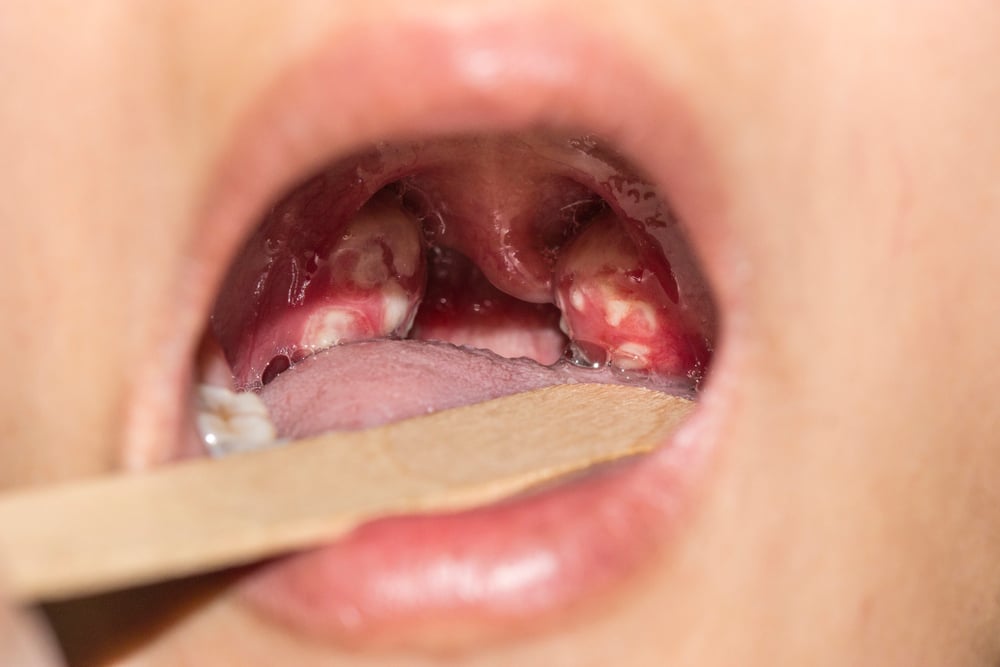 Quan hệ bằng miệng xong đau họng là bị gì? Cẩn thận với 6 bệnh xã hội
