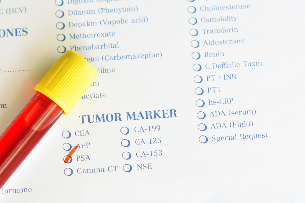 Marker ung thư là gì? Marker của các bệnh ung thư thường gặp
