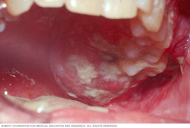 Những hình ảnh ung thư khoang miệng giúp phát hiện bệnh từ sớm