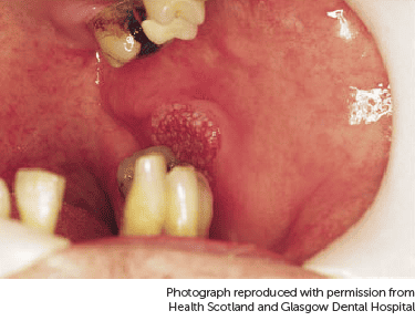 Những hình ảnh ung thư khoang miệng giúp phát hiện bệnh từ sớm
