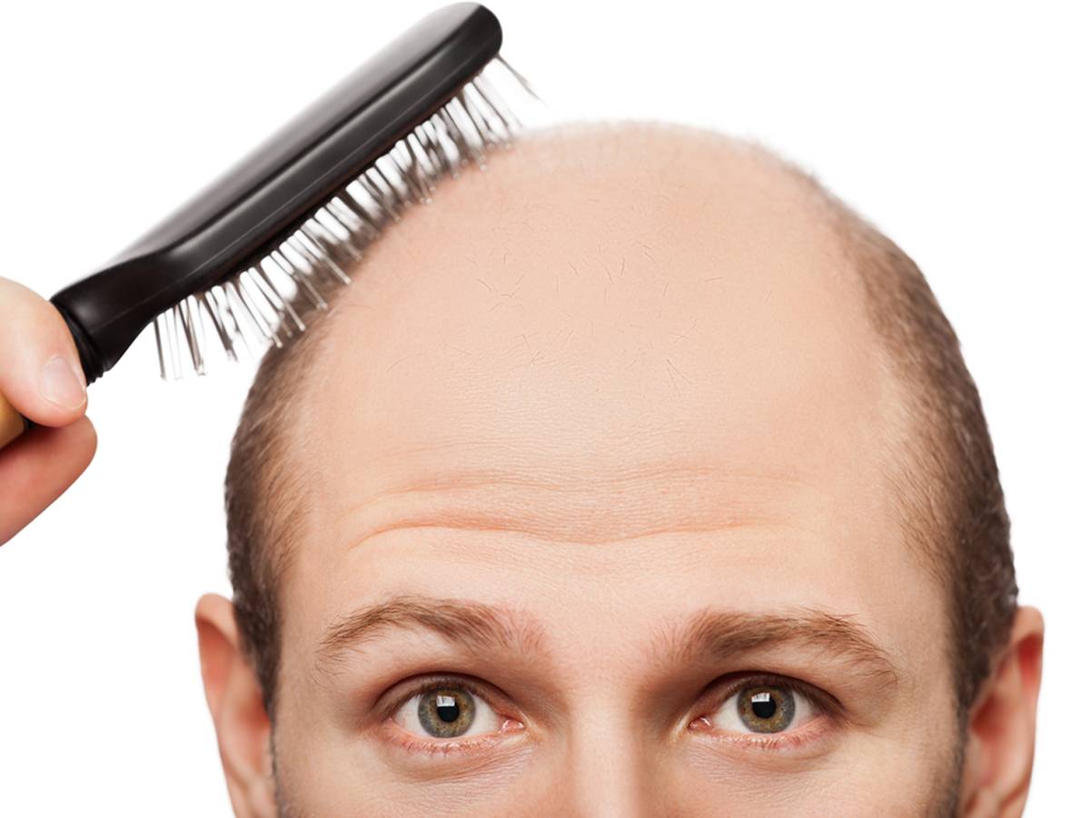 Rụng tóc ở nam giới: Nỗi lo của cánh mày râu