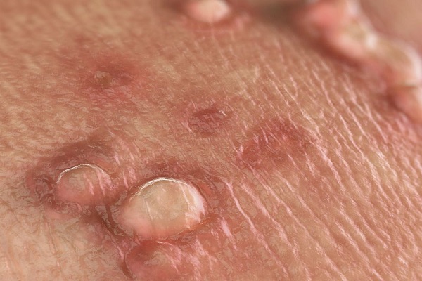 Bệnh da liễu thường gặp ở nam giới là những bệnh gì?