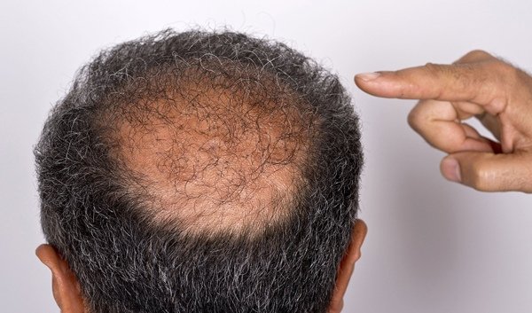 Bạn biết gì về chứng rối loạn cào da, bứt tóc?