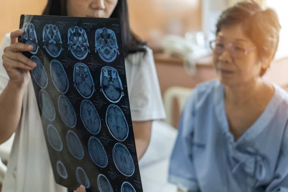 5 bài thuốc chữa tai biến mạch máu não bằng Đông y có thể bạn chưa biết