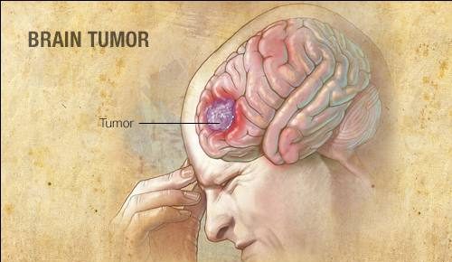 Ung thư não: Triệu chứng, nguyên nhân và điều trị