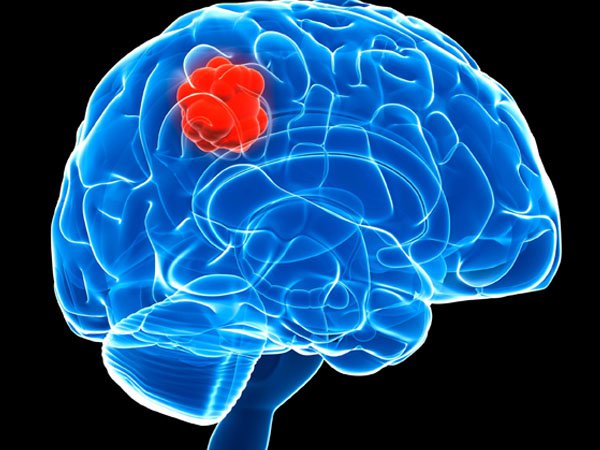 Áp xe não: Nguyên nhân là gì và chẩn đoán như thế nào?