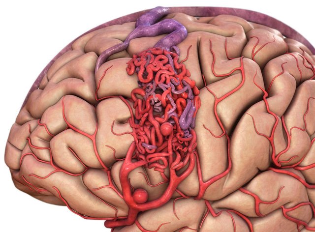 Dị dạng mạch máu não thể hang, bệnh lý mơ hồ tiềm ẩn nhiều nguy cơ