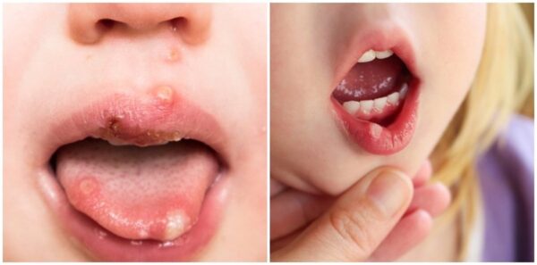Top 5 loại thuốc bôi nhiệt miệng cho trẻ em hiệu quả