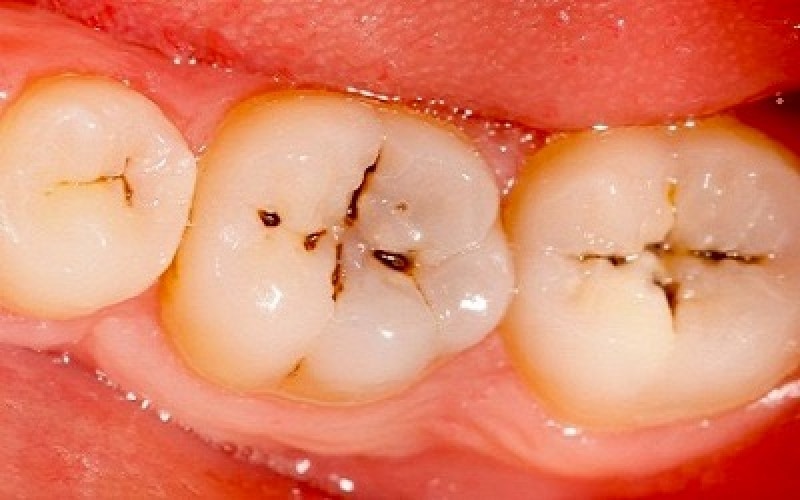 Những cách trị răng ố vàng hiệu quả mà đơn giản