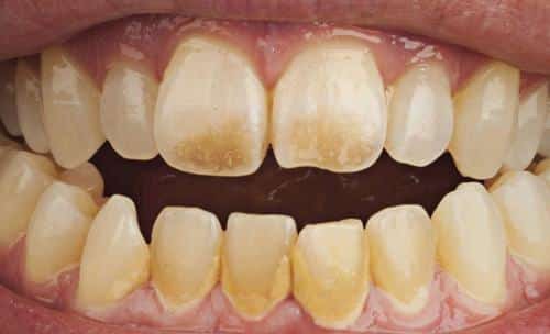 Cách tẩy răng ố vàng dễ hay khó và câu trả lời của bác sĩ