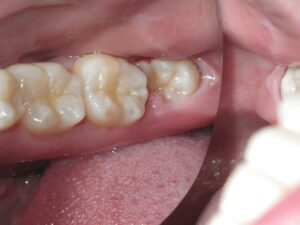 Răng khôn mọc lệch: Hiểu đúng và hiểu sai
