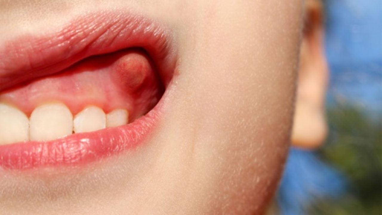 Áp xe răng: Bệnh lý nha khoa bạn cần cẩn thận!