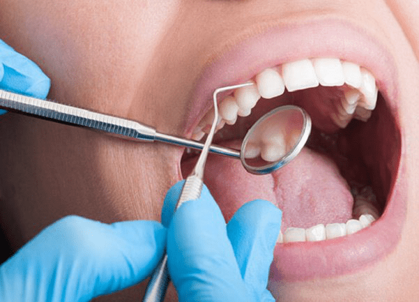 Áp xe răng: Bệnh lý nha khoa bạn cần cẩn thận!