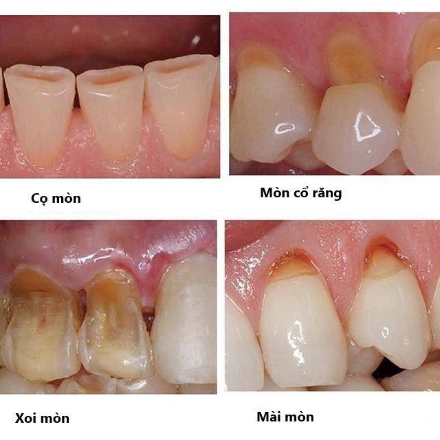 Mòn răng: Vấn đề nan giải của cuộc sống hiện đại