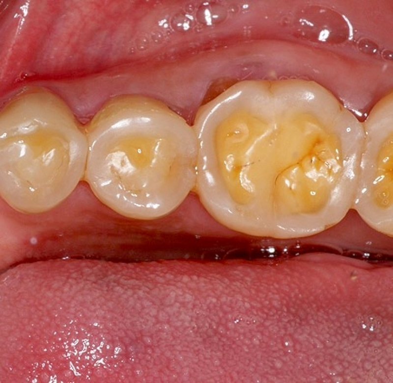 Mòn răng: Vấn đề nan giải của cuộc sống hiện đại