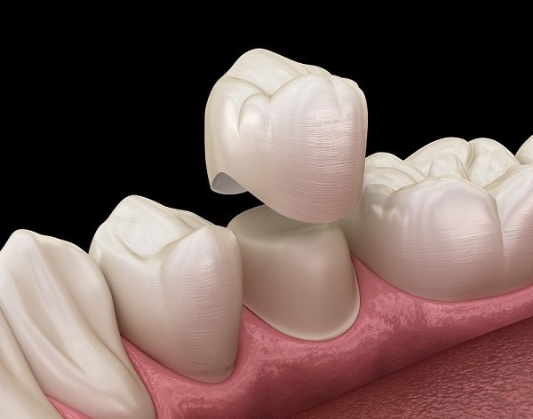 Mẻ răng: Nguyên nhân và cách khắc phục