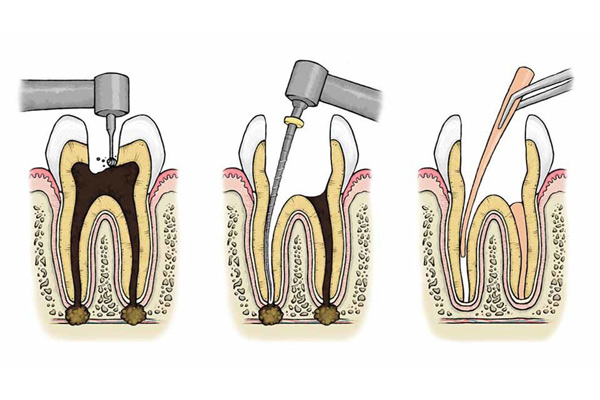 Đau nhức răng: Nguyên nhân, cách điều trị và phòng ngừa