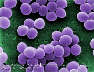 Những điều bạn cần biết về viêm khớp nhiễm khuẩn