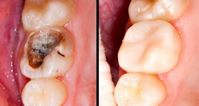 Viêm tủy răng – bệnh lý thường gặp trong nha khoa