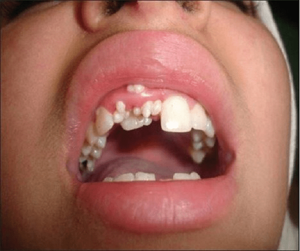 U răng là gì? Đặc điểm, nguyên nhân, cách điều trị