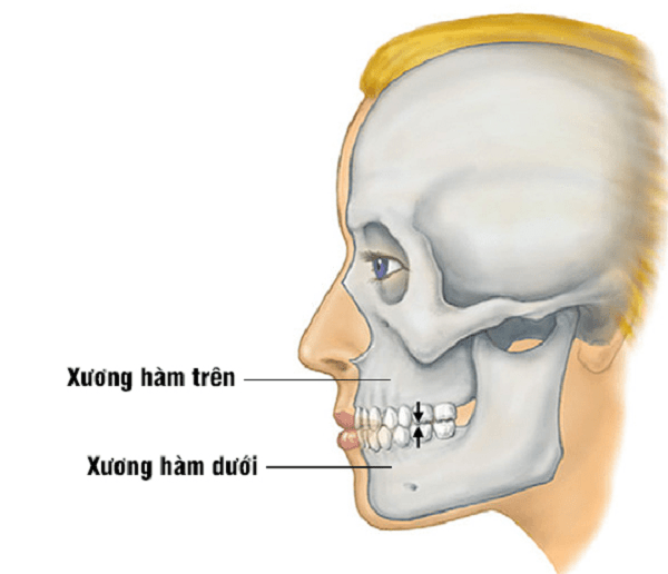 Gãy xương hàm trên: nguyên nhân, triệu chứng, chẩn đoán và cách điều trị