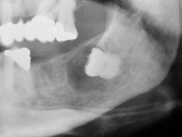 Nang thân răng: nguyên nhân, chẩn đoán và cách điều trị