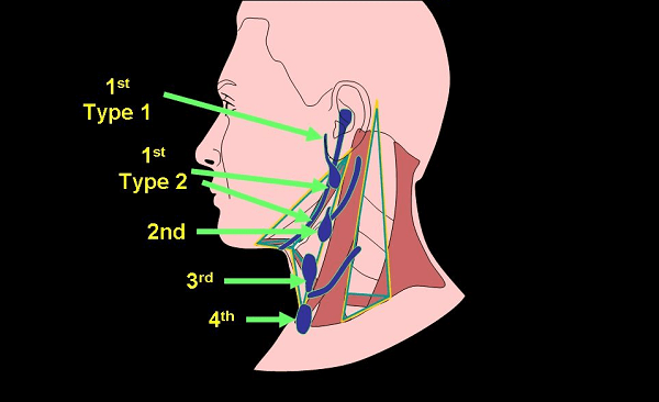 Nang khe mang: Nang mô mềm ít gặp vùng đầu mặt
