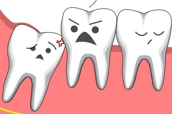 Đau răng khôn và những cách giảm đau bạn nên biết