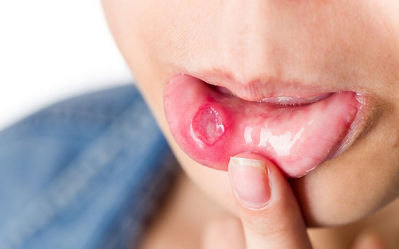Liệu bạn đã biết về nhiệt miệng (loét miệng) – căn bệnh gây nhiều phiền toái?