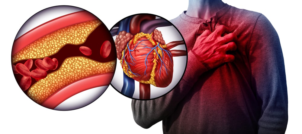 Tìm hiểu nguyên nhân nhồi máu cơ tim để biết cách phòng ngừa