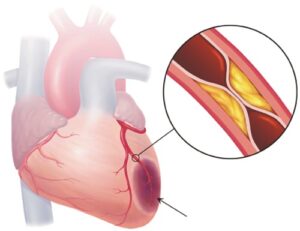 Đau thắt ngực nguy cơ bệnh tim tiềm ẩn