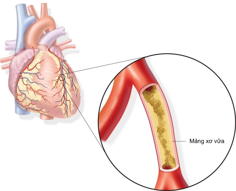 Thiếu máu cơ tim: Những gì bạn nên biết