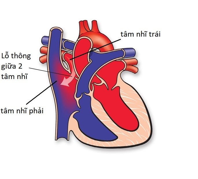 Bệnh tim bẩm sinh: Thông liên nhĩ – Thông liên thất