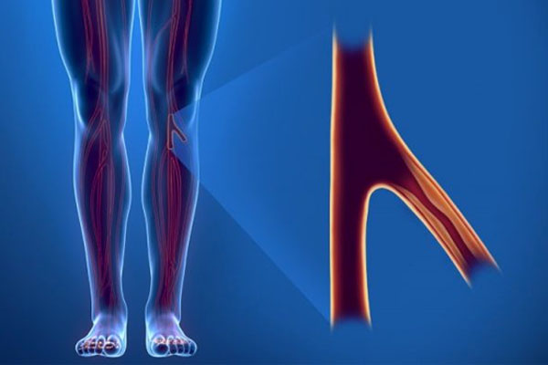 Bệnh lý động mạch chủ chi dưới: Mùa đông và những cơn đau chân
