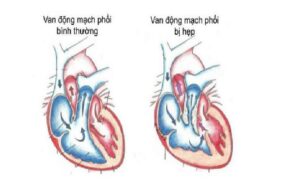 Hẹp van động mạch phổi: Bệnh van tim nguy hiểm và những điều cần biết