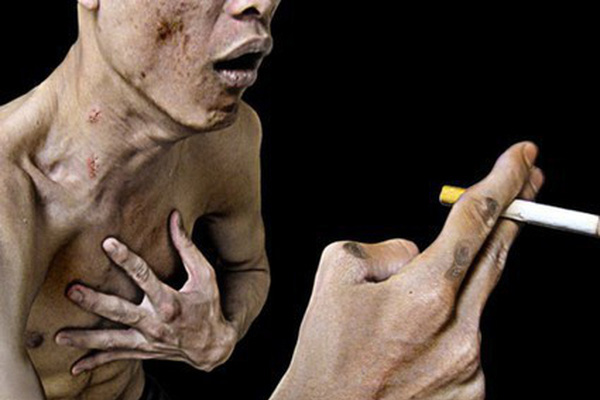 Tăng áp động mạch phổi: Sát thủ âm thầm