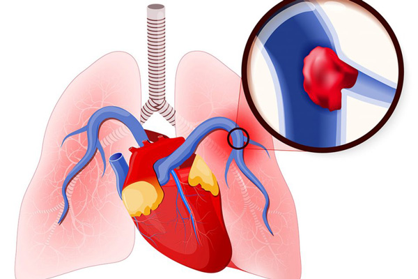 Tăng áp động mạch phổi: Sát thủ âm thầm