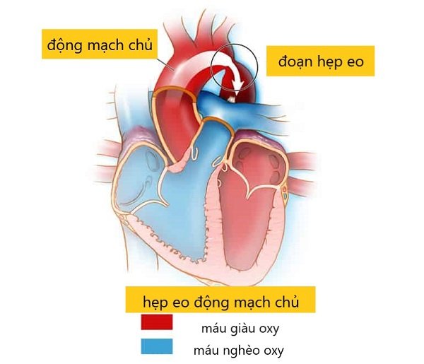 Hẹp eo động mạch chủ: Bệnh tim bẩm sinh dễ bị bỏ sót