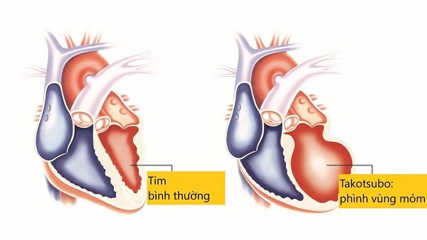 Bệnh cơ tim Takotsubo: Tình trạng suy tim cấp có thể đảo ngược!