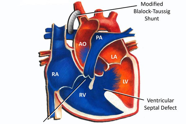 Tứ chứng Fallot: Bệnh tim bẩm sinh tím thường gặp nhất
