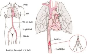 Thuyên tắc động mạch phổi: Cái chết bất ngờ
