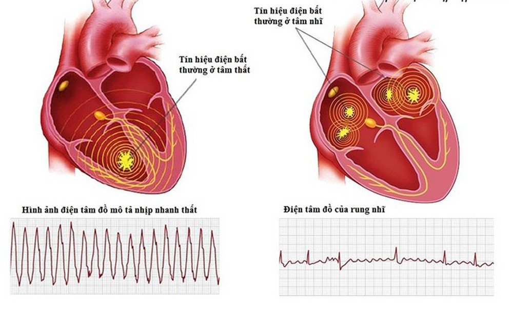Nhịp nhanh thất: Rối loạn nhịp tim bạn không thể chủ quan!