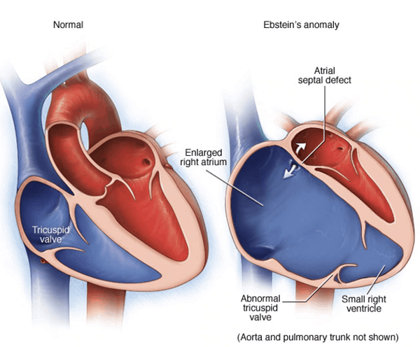 Bệnh tim Ebstein- nguyên nhân, chẩn đoán và điều trị