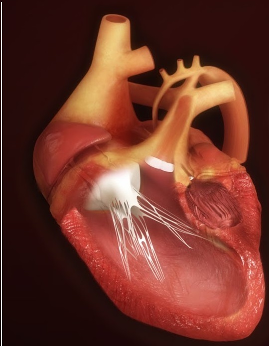 Hội chứng thiểu sản tim trái: Nguyên nhân, triệu chứng và điều trị