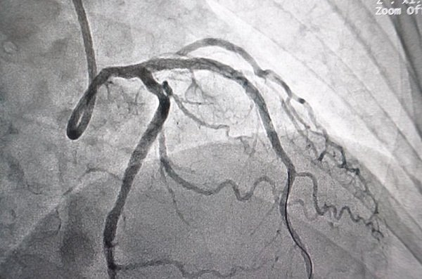Bóc tách động mạch vành tự phát: cấp cứu tim mạch hiếm gặp và những điều cần biết