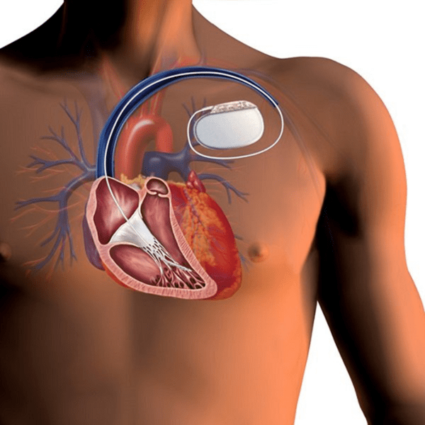 Bệnh cơ tim phì đại: Nguyên nhân, triệu chứng và điều trị