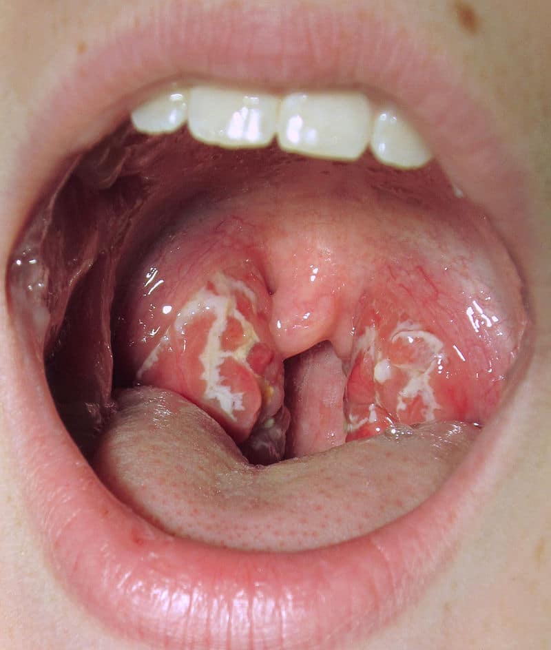 Viêm họng hạt ở trẻ em: nguyên nhân, triệu chứng và cách điều trị